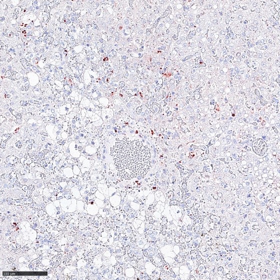 Abbildung 2: Leber eines Frettchens nach Infektion mit Reston Ebolavirus. Immunhistochemischer Nachweis des Reston Ebolavirusproteins (rot-braun) und Hämatoxylin Gegenfärbung (blau). Das Virusprotein ist überwiegend in ortsständigen Makrophagen und in Leberzellen zu finden. Maßstabsbalken 100µm.