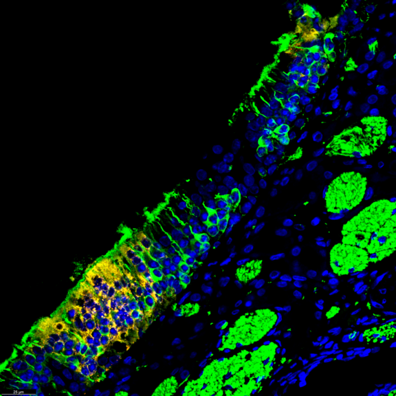 Nachweis von MERS-Coronavirus Antigen in Neuronen des Riechepithels in der Nase eines Hamsters: Doppelmarkierung der positiven, gelben Zellen durch Überlagerung der Farben Rot (Nachweis von MERS-Coronavirus Antigen) und Grün (Nachweis von TUJ1 in olfaktorisch-sensorischen Neuronen). Die Zellkerne wurden mit DAPI (blau) markiert.